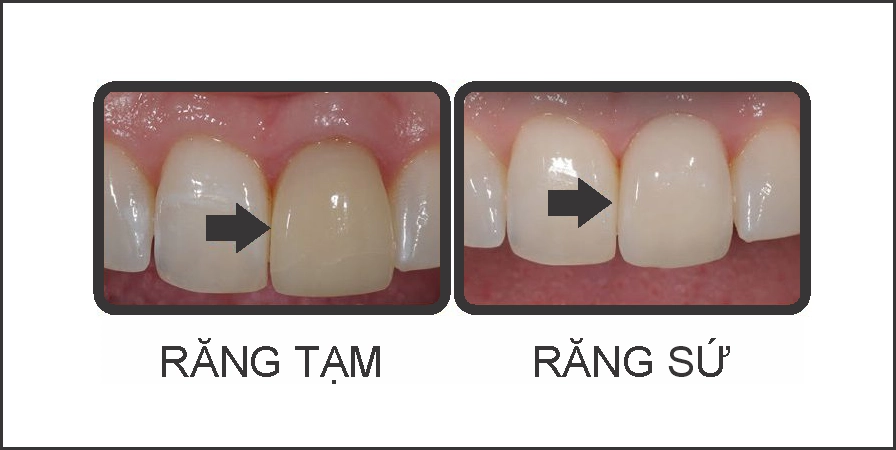 Gắn răng tạm bảo vệ cùi răng trước khi bọc mão sứ